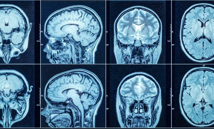 Yapay zeka beyin tümöründe devrim yaratıyor